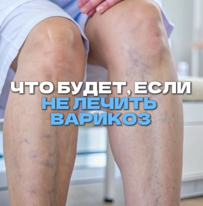 Опасности несвоевременного лечения варикоза: от боли до тромбов.