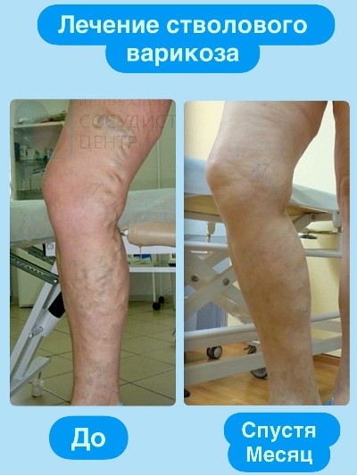 Как избавиться от варикоза: опыт пациента и результаты лечения.