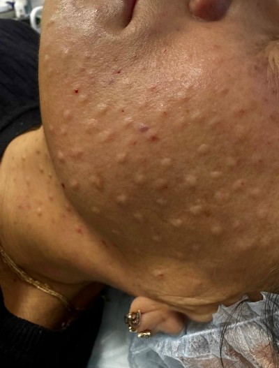 Биоревитализация весной: почему это идеальное время и почему папулы — это нормально.